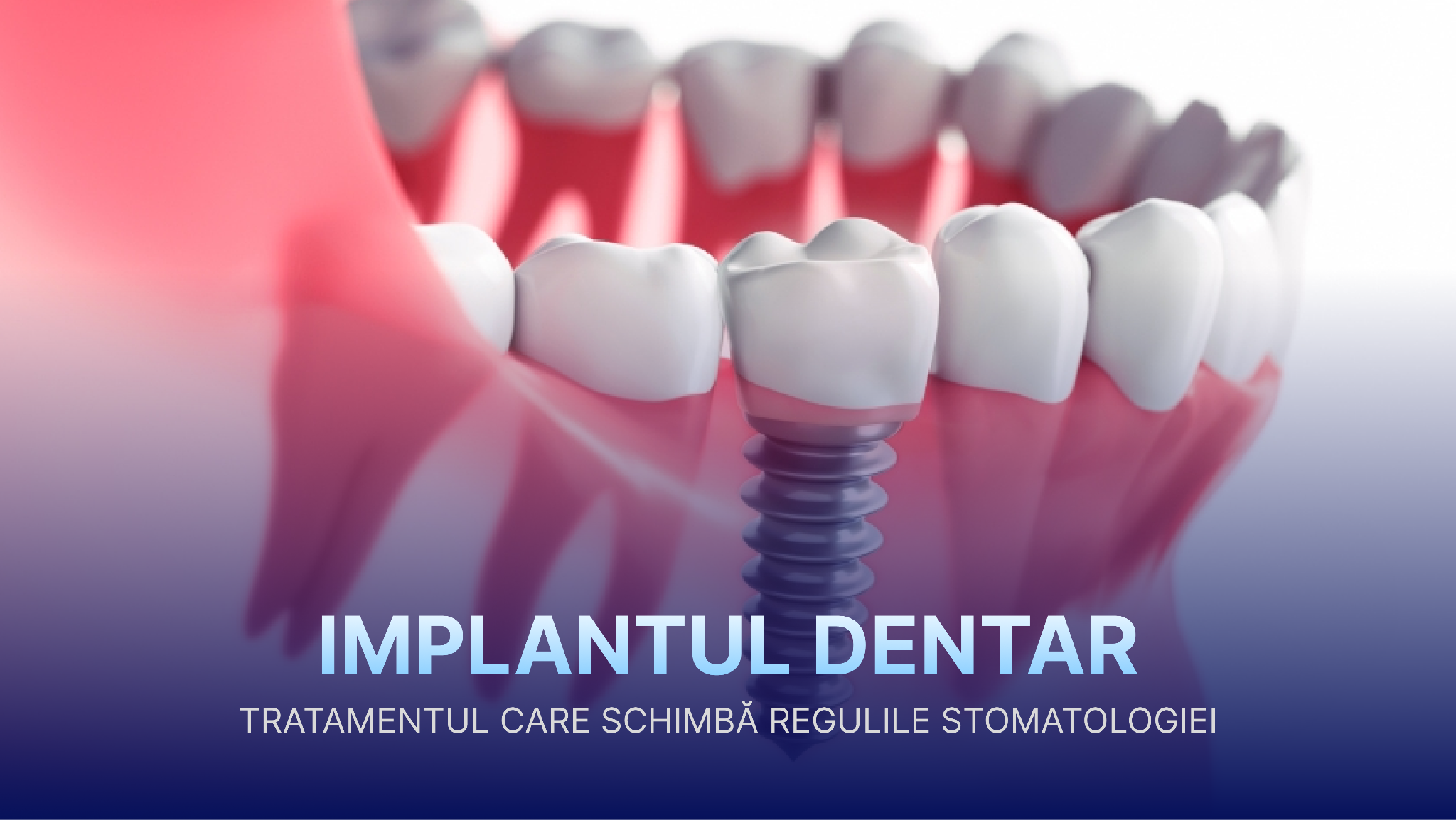 Cum afli costul unui implant dentar în București și ce include, de fapt, prețul final